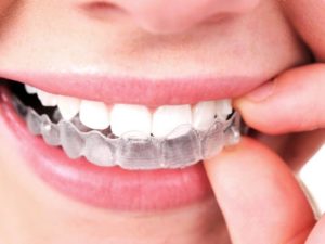 Ortodonzia INVISIBILE? Possibile! - Centro Dentale Palazzo Al Ponte